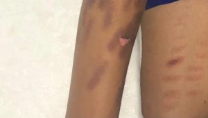 Gebzeli şahıs lazer epilasyon sonrası mağdur oldu