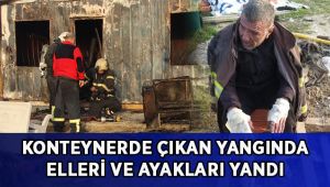 Konteynerde çıkan yangında elleri ve ayakları yandı